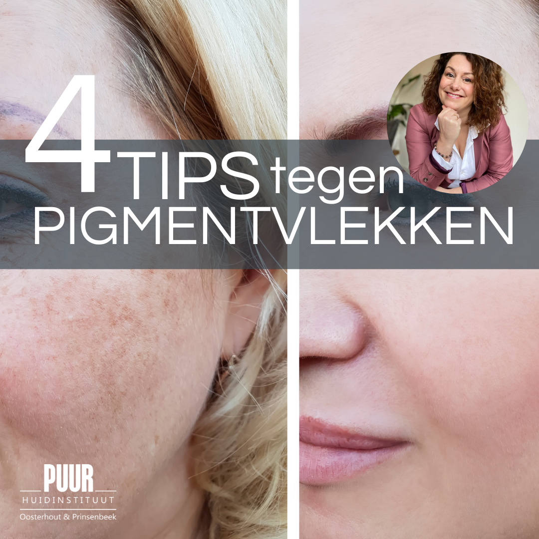 pigment pigmentvlek tranexaminezuur peeling tca