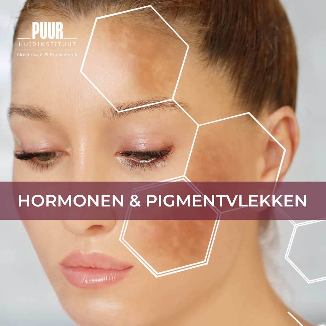 HORMOON HORMONEN PIGMENT PIGMENTVLEK MELASMA