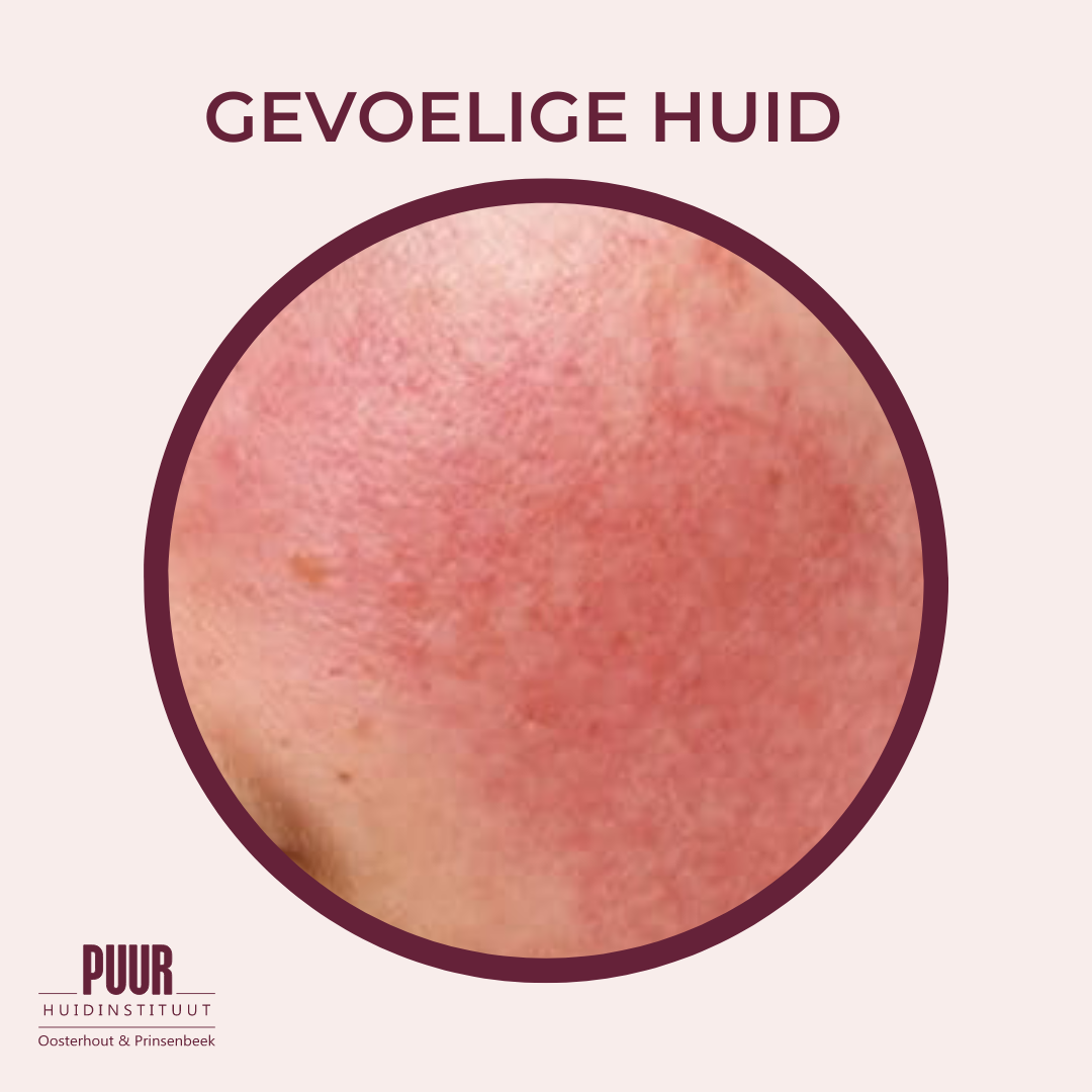 gevoelige huid voorkomen tips huidexpert huidinstituut skincare webshop verminderen behandelen puur