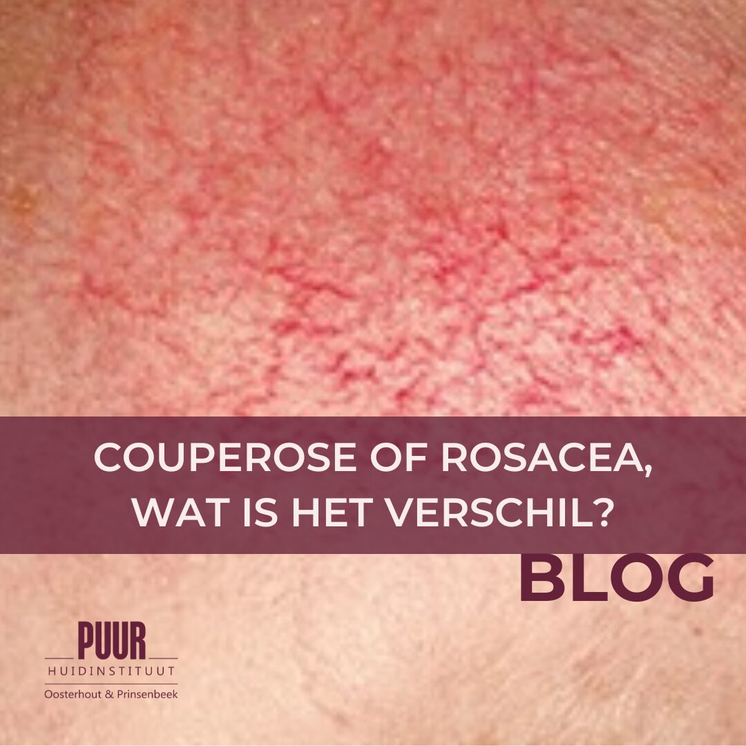 verschil rosacea en couperose puur huidinstituut